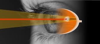 Laser Vitreolysis — treatment for eye floaters